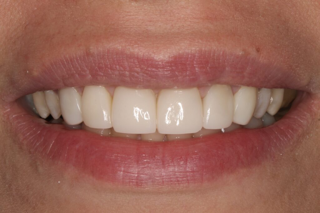 10 - After - New Bioclear Smile!