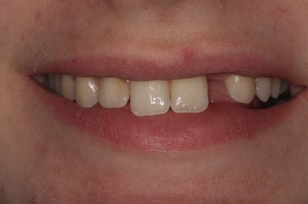 1 - Before - Missing tooth on young person; typical problem seen