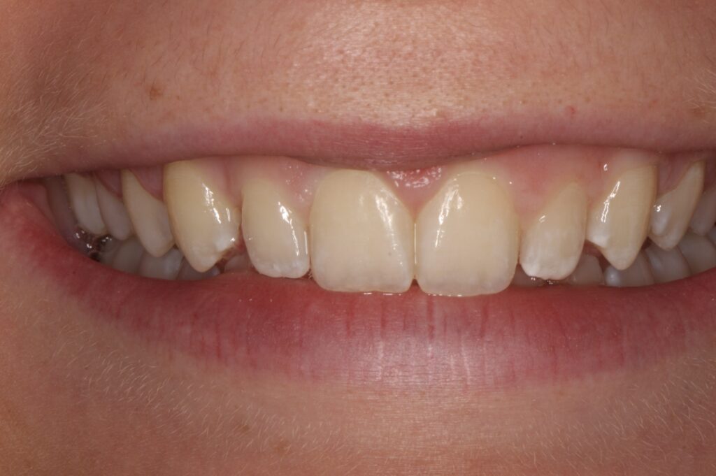 Small lateral incisors typical problem often solved with porcelain crowns