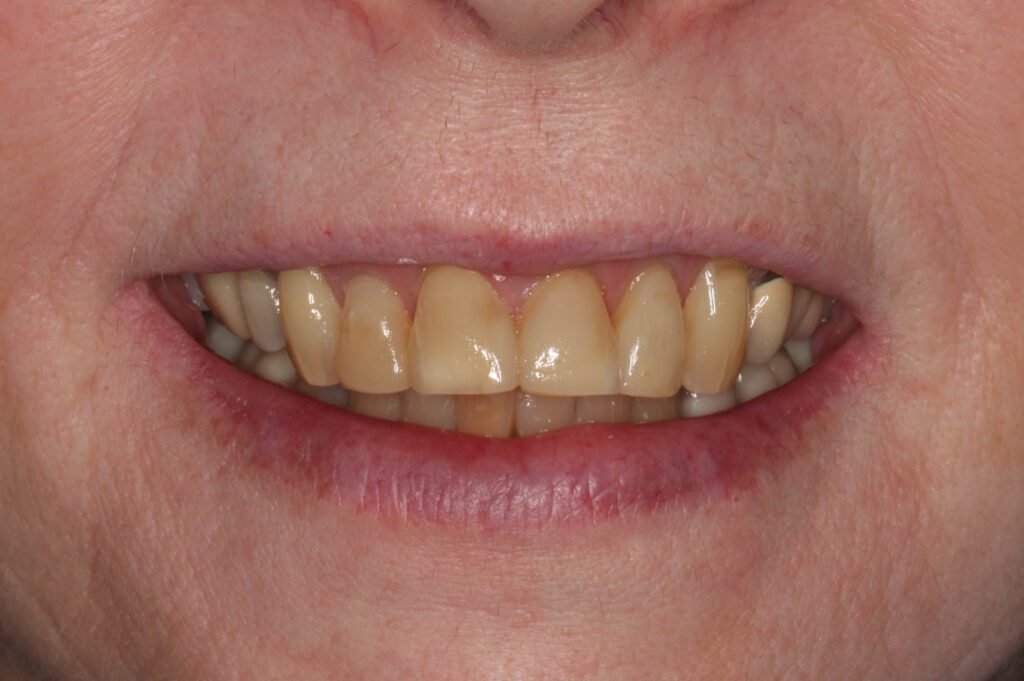 1 - Before - Yellowed teeth; patient desired minimal cutting