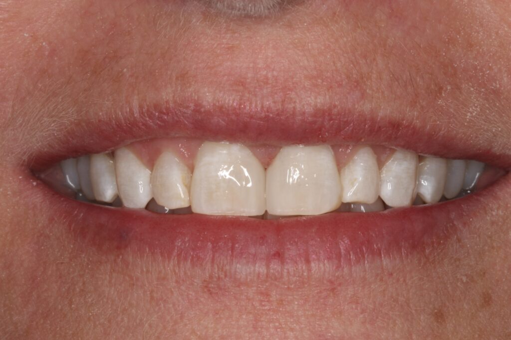 1 - After - Bioclear closes the space; no tooth grinding!