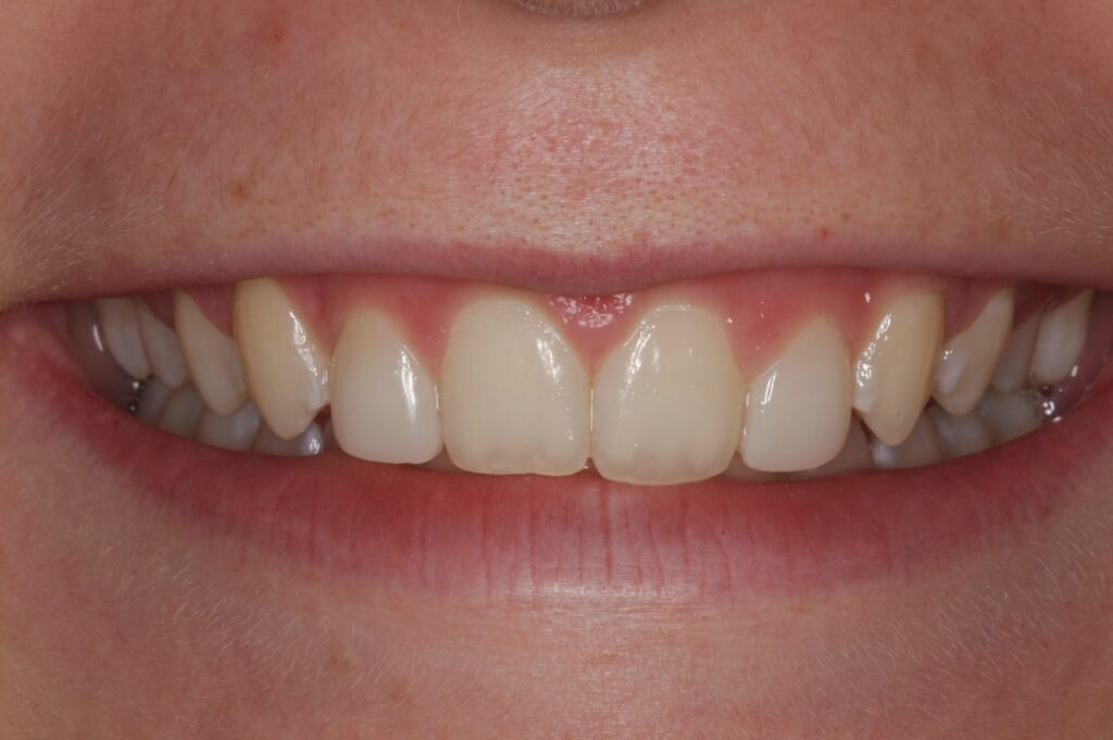 Bioclear result without need for crowns