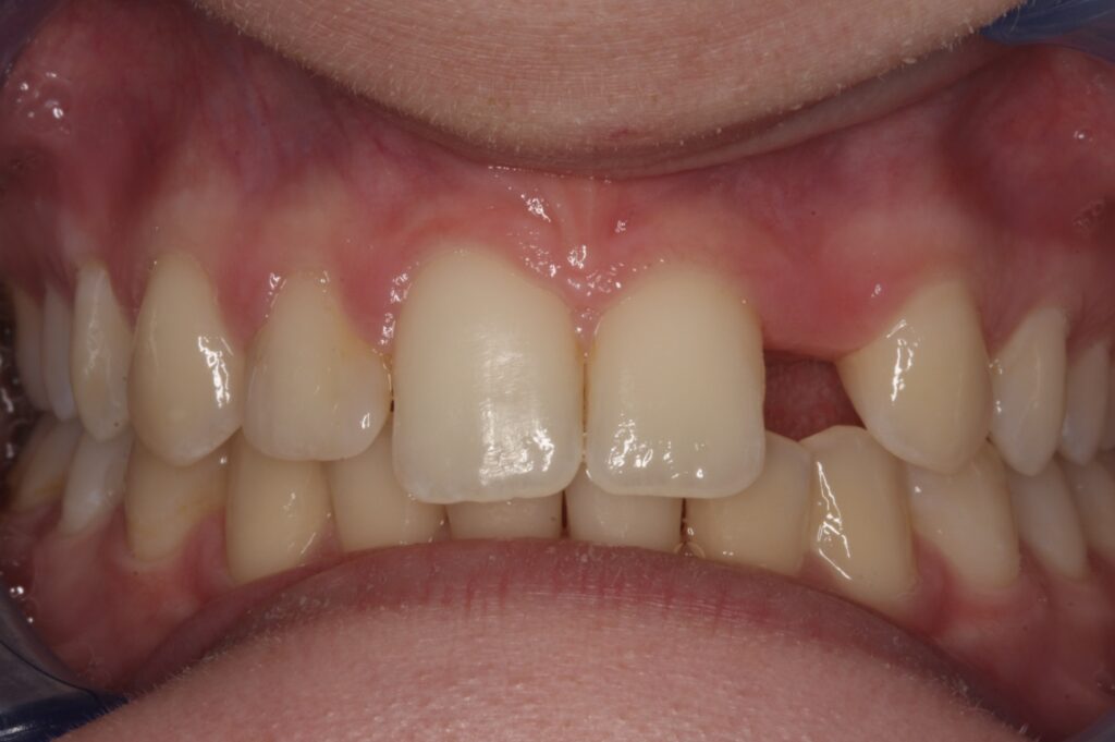 1 - Before - Close up view of missing tooth, patient too young for implant