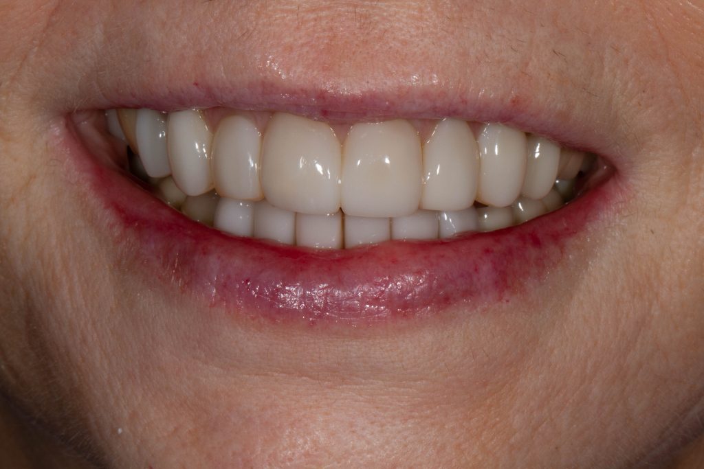 1 - After - New Bioclear Smile