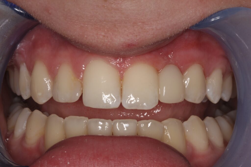 1 - After - Close up of Bioclear tooth replacement without cutting of any teeth for bridge