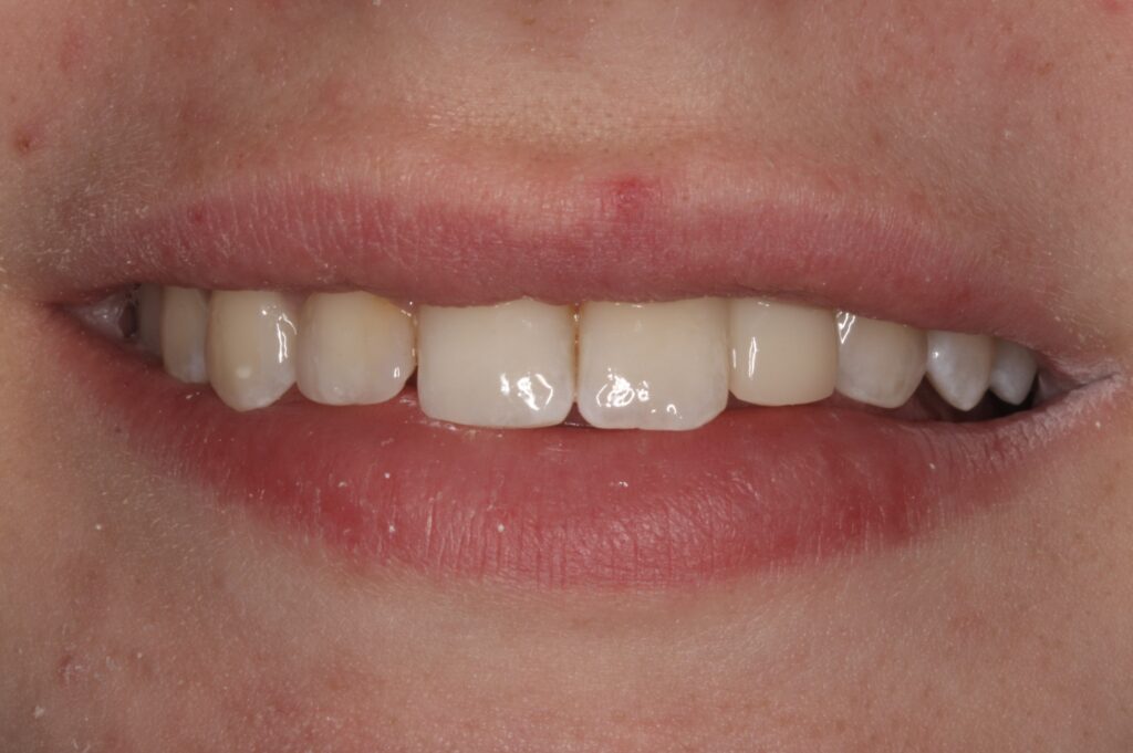 1 - After = Patient can smile again, thanks to Bioclear