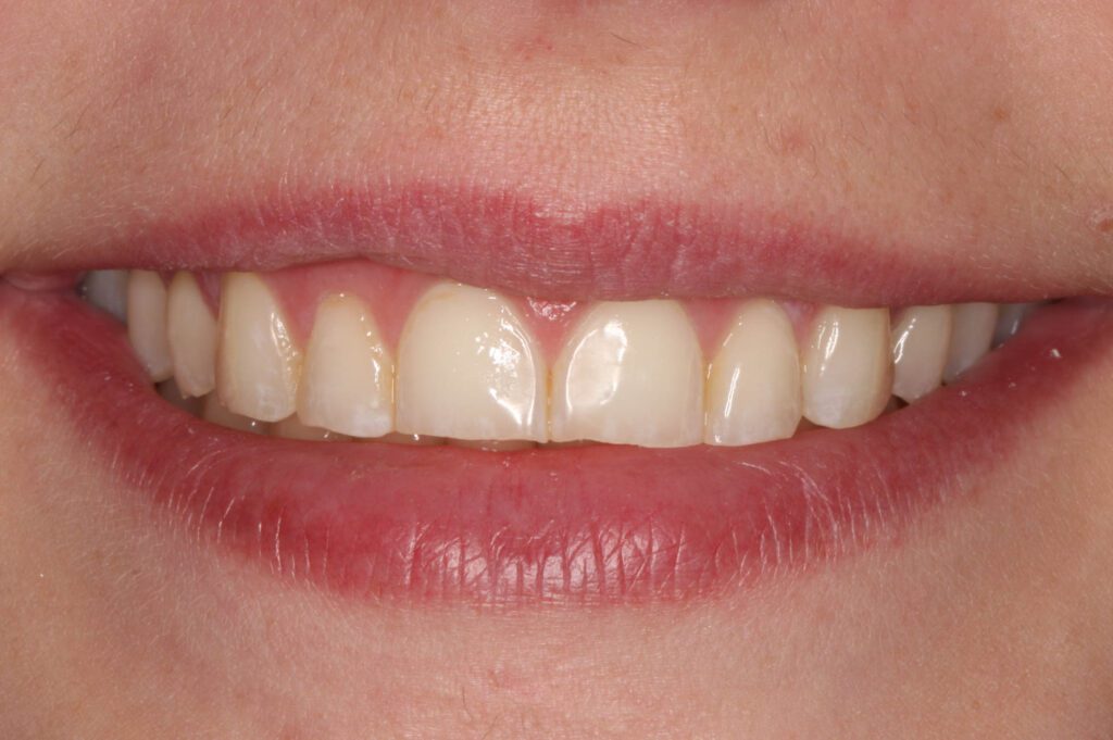 2 - Before - Worn teeth, patient desired longer teeth and youthful smile