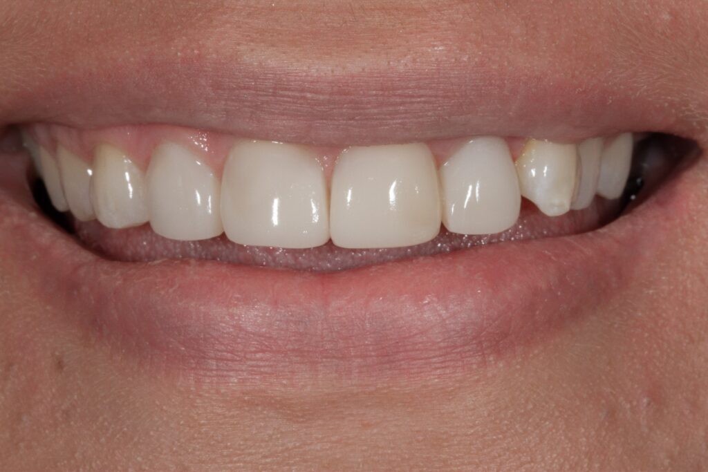 3 - After - Bioclear Smile
