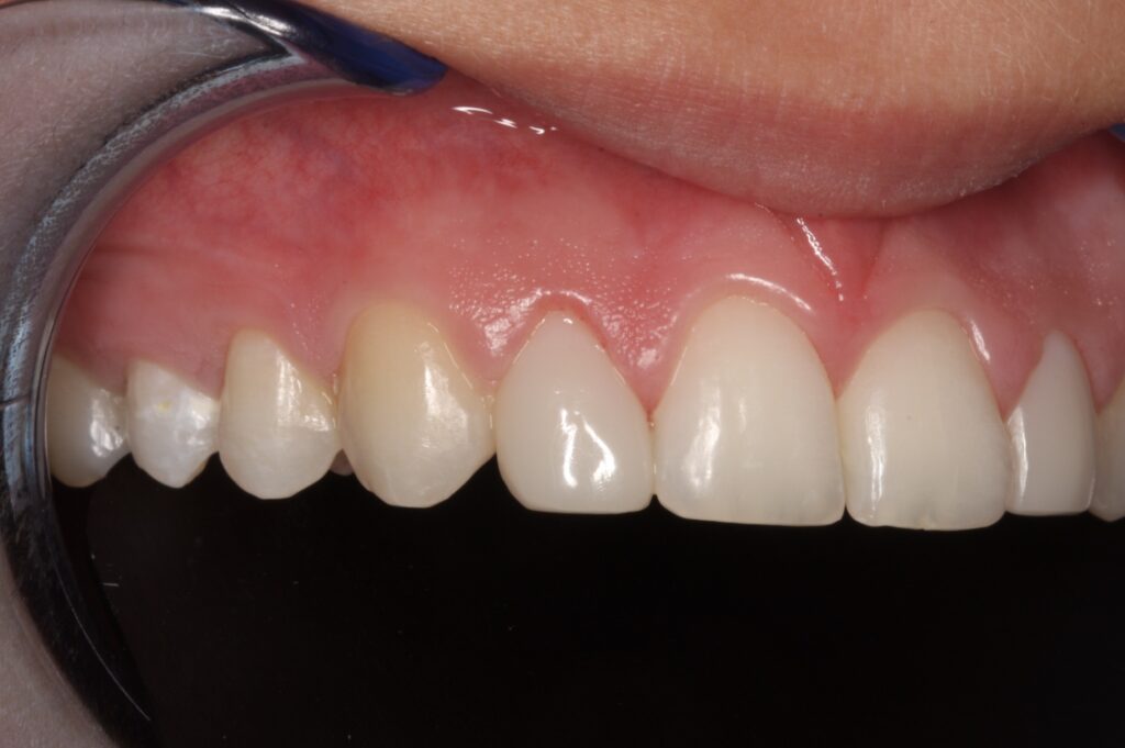 Side view of Bioclear-answer to small incisor