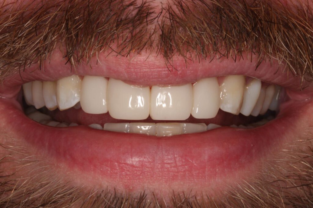 6 - After - Beautiful "shrink-wrapped" Bioclear teeth
