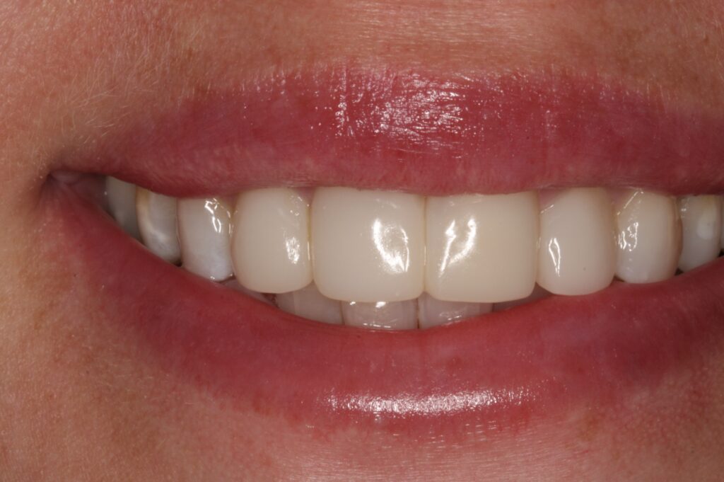 7 - After - New Bioclear Smile, Stronger than crowns!