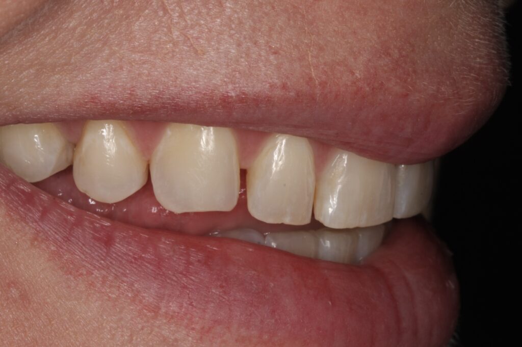 8 - Before - Short teeth, spaces and color issues that patient doesn't like
