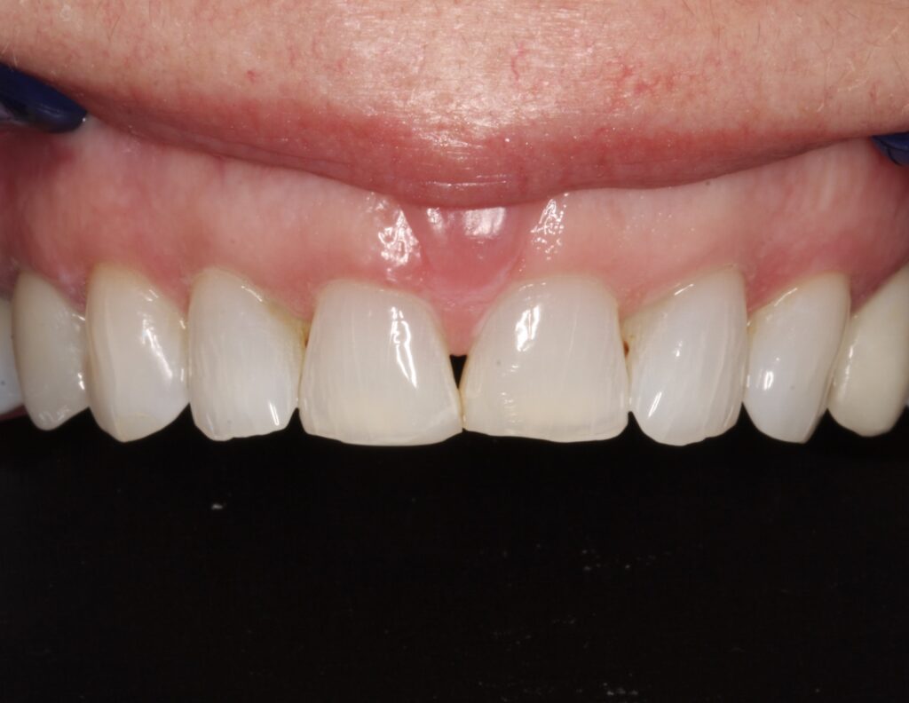 9 - Before - Front four teeth with long history of chipping, thin and weak teeth, black triangle