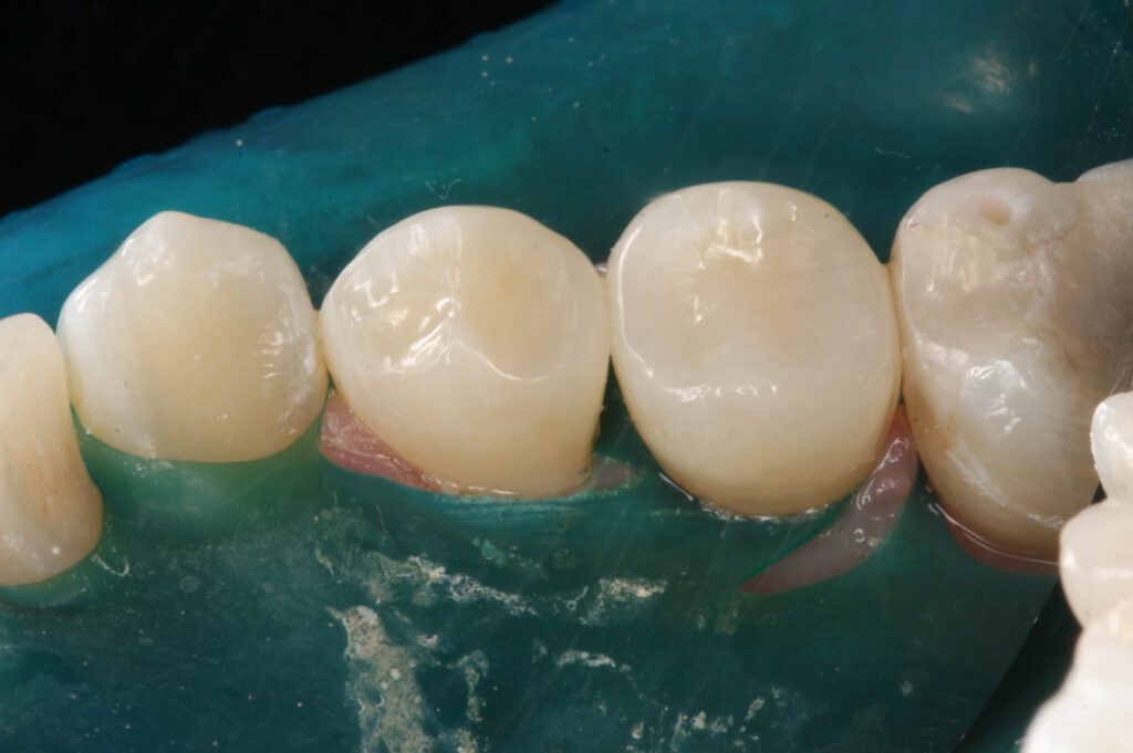 Back Teeth/Molars